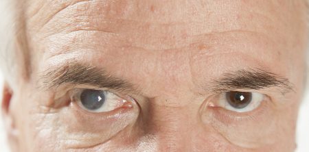 Cataracts Awareness: What You Need to Know